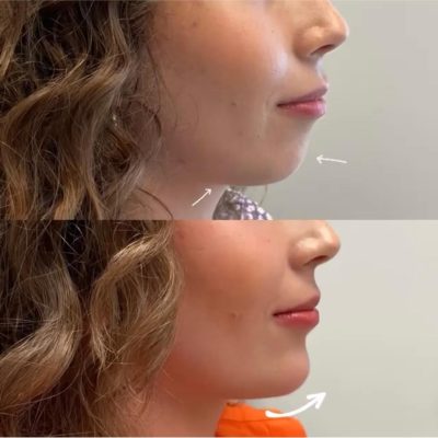 jawline-double-menton-2