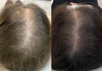 perte-cheveux